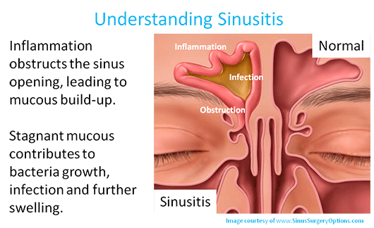 Sinusitis 2 Wake Ear Nose And Throat